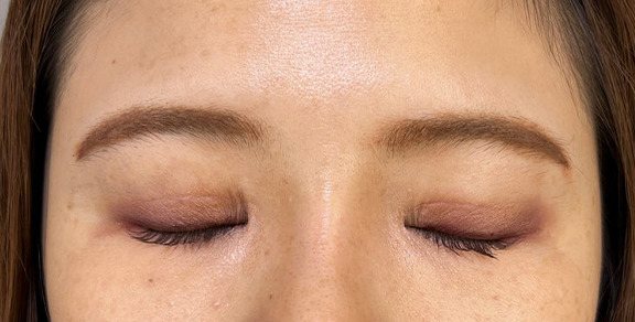 症例写真,二重まぶた切開法で眼瞼下垂手術と同じくらい目をパッチリさせた症例写真,After(目を閉じた状態)<br/>
(3ヶ月後),