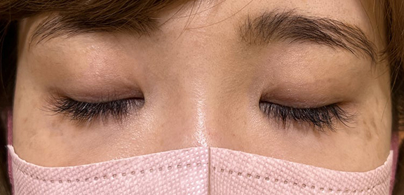 症例写真,末広型の二重を裏留め埋没法でmix型の二重にした症例写真,After(目を閉じた状態)<br/>
(3ヶ月後),