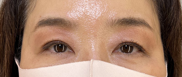 二重まぶた・全切開法,埋没法で作った二重を全切開法で固定した症例写真,3ヶ月後,メイクあり,mainpic_sekkai093c.jpg