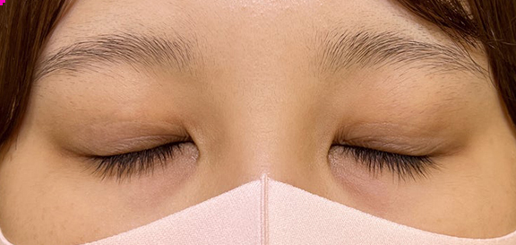 症例写真,奥二重に近い末広型二重を裏留め埋没法でmix型の二重にした症例写真,After(目を閉じた状態)<br/>
(1ヶ月後),