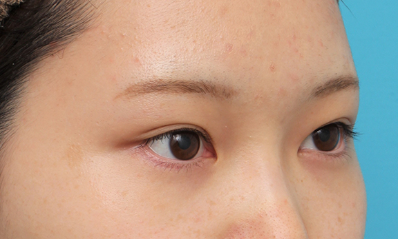 症例写真,グラマラスライン(垂れ目形成手術)を行った20代女性の症例写真,After(6ヶ月後),ba_panda023_b02.jpg