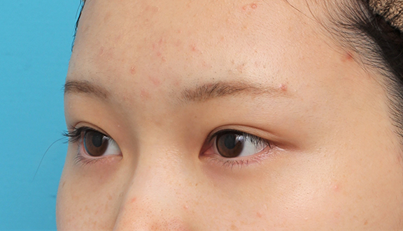 症例写真,グラマラスライン(垂れ目形成手術)を行った20代女性の症例写真,After(6ヶ月後),ba_panda023_b03.jpg