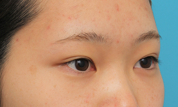 症例写真,グラマラスライン(垂れ目形成手術)を行った20代女性の症例写真,Before,ba_panda023_b02.jpg