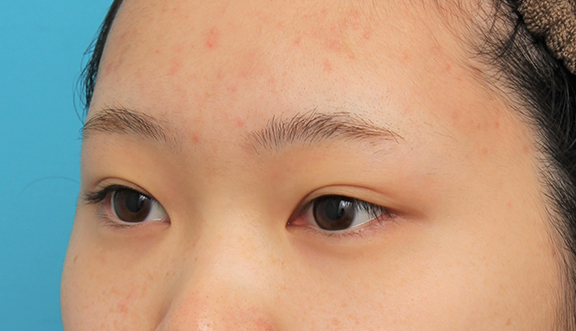 症例写真,グラマラスライン(垂れ目形成手術)を行った20代女性の症例写真,Before,ba_panda023_b03.jpg