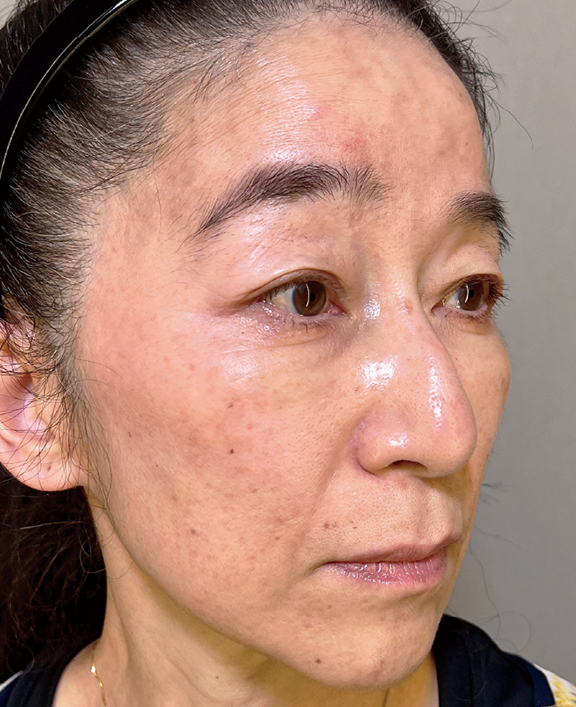 症例写真,しわ取りボトックスとヒアルロン酸を行った女性の症例写真,After(2週間後),ba_botox018_b02.jpg
