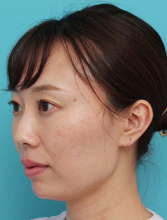 症例写真,顎と唇にヒアルロン酸を注入した20代女性の症例写真,After(手術後),ba_agochu019_b02.jpg