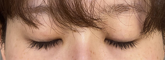 症例写真,当日からメイクができる裏留め埋没法で目尻側広めのmix型二重を作った症例写真,After(目を閉じた状態)<br/>
(1週間後),