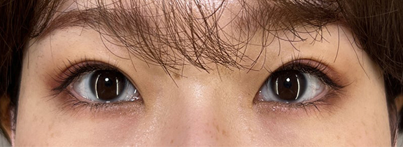 症例写真,当日からメイクができる裏留め埋没法で目尻側広めのmix型二重を作った症例写真,After(目を開けた状態)(メイクあり)<br/>
(1週間後),