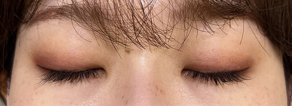 症例写真,当日からメイクができる裏留め埋没法で目尻側広めのmix型二重を作った症例写真,After(目を閉じた状態)(メイクあり)<br/>
(1週間後),