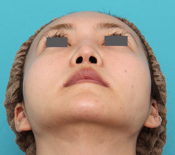 症例写真,人中短縮+口角挙上+小鼻縮小を行った30代女性症例写真,After(6ヶ月後),ba_hanashita009_b02.jpg