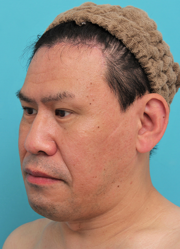 症例写真,額の切開リフトを行った40代男性の症例写真,After(6ヶ月後),ba_hitailift004_b02.jpg
