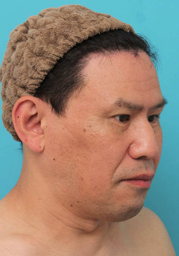 症例写真,額の切開リフトを行った40代男性の症例写真,After(6ヶ月後),ba_hitailift004_b03.jpg