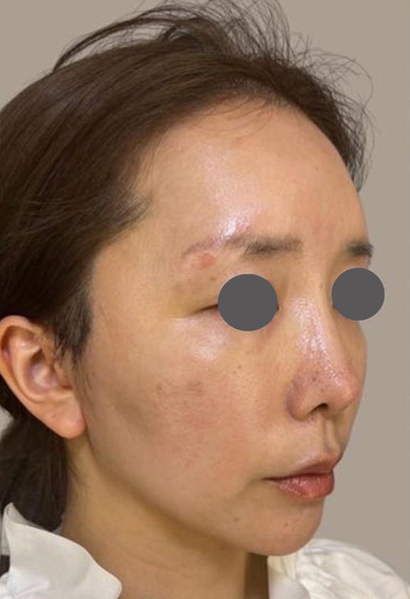 症例写真,30代のたるみの少ない方のミニフェイスリフトの症例写真,After(1ヶ月後),ba_minilift015_b02.jpg