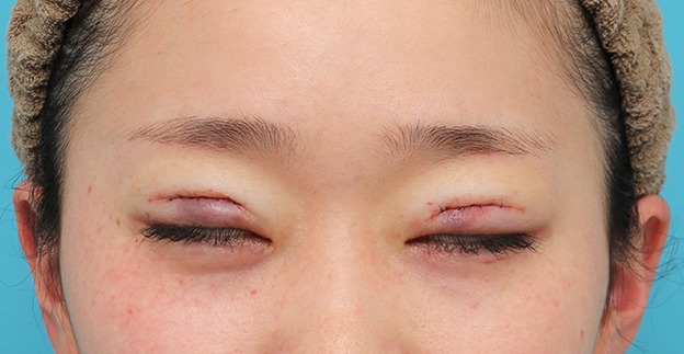二重まぶた・ミニ切開法（部分切開）,二重まぶたミニ切開法で幅広平行型二重を作った20代女性の症例写真,手術直後,mainpic_mini_sekkai45d.jpg