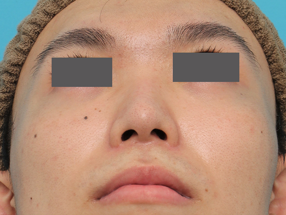 症例写真,小鼻縮小手術を行った20代男性の症例写真,After(6ヶ月後),ba_biyoku054_b02.jpg