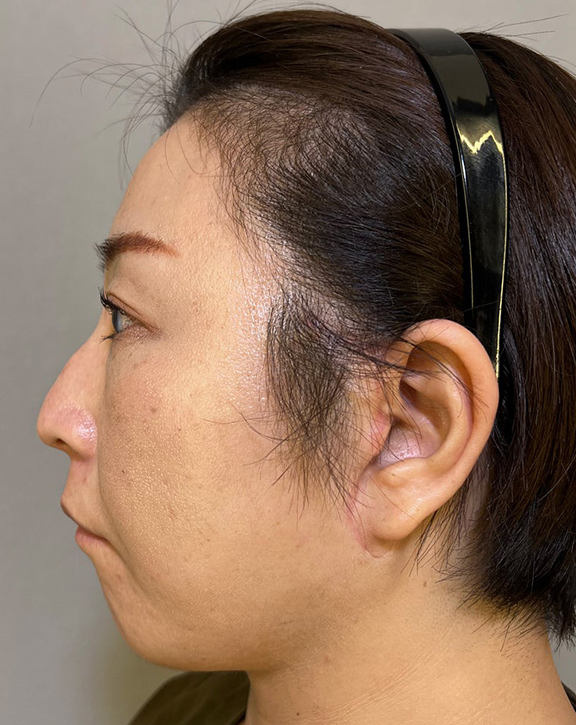 症例写真,ミニフェイスリフトで口元のたるみを改善した女性の症例写真,After(3ヶ月後),ba_minilift016_b02.jpg