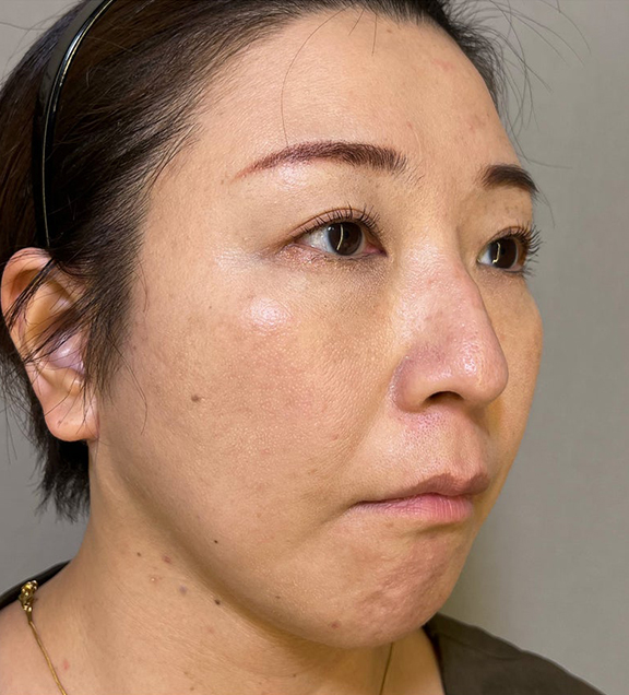 症例写真,ミニフェイスリフトで口元のたるみを改善した女性の症例写真,After(3ヶ月後),ba_minilift016_b03.jpg
