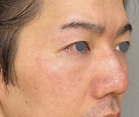 症例写真,耳介軟骨移植(クローズド法)で鼻を伸ばした症例写真,After(1ヶ月後),ba_jikai049_b02.jpg