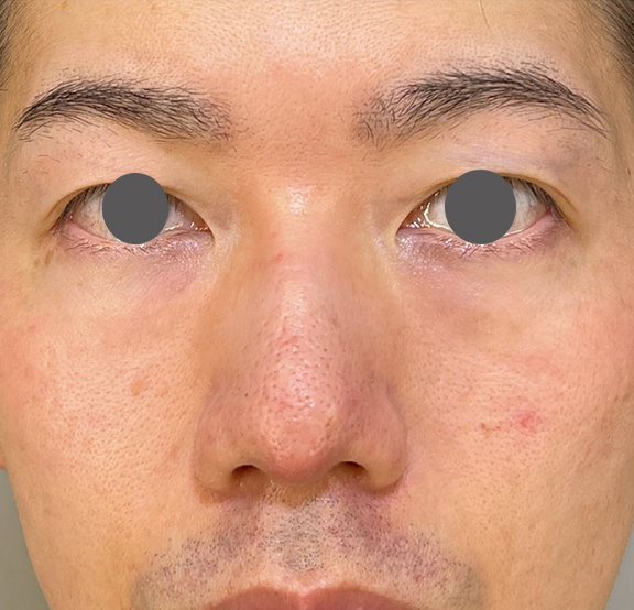 症例写真,耳介軟骨移植(クローズド法)で鼻を伸ばした症例写真,After(1ヶ月後),ba_jikai049_b03.jpg