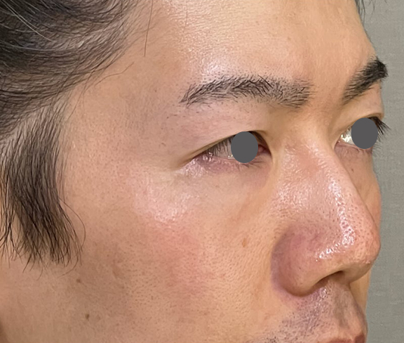 症例写真,耳介軟骨移植(クローズド法)で鼻を伸ばした症例写真,Before,ba_jikai049_b02.jpg