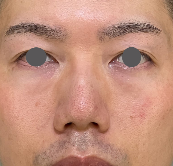 症例写真,耳介軟骨移植(クローズド法)で鼻を伸ばした症例写真,Before,ba_jikai049_b03.jpg