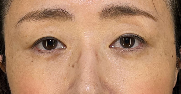 目の下の脂肪取り,目の下の切らない脂肪取り+眼窩脂肪移植の症例写真,After(1ヶ月後)(メイクあり),ba_shibo_under002_b02.jpg