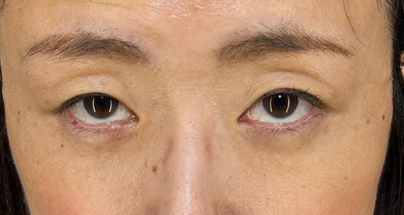 目の下の脂肪取り,目の下の切らない脂肪取り+眼窩脂肪移植の症例写真,After(1ヶ月後)(メイクあり),ba_shibo_under002_b03.jpg