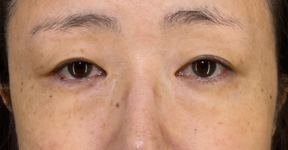 目の下の脂肪取り,目の下の切らない脂肪取り+眼窩脂肪移植の症例写真,Before,ba_shibo_under002_b02.jpg