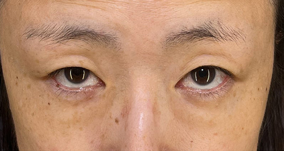 目の下の脂肪取り,目の下の切らない脂肪取り+眼窩脂肪移植の症例写真,Before,ba_shibo_under002_b03.jpg