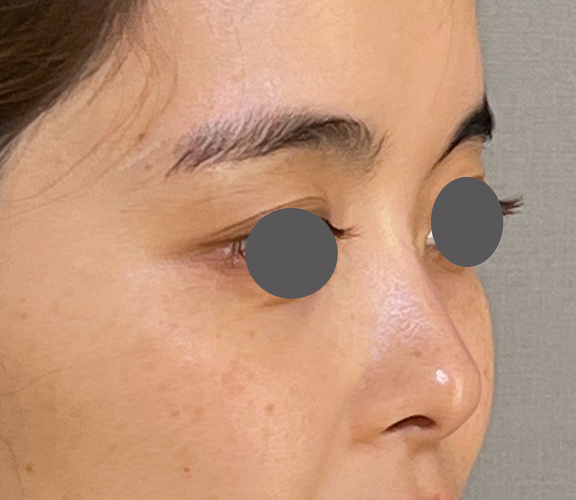 耳介軟骨移植(鼻先を出す),耳介軟骨移植で鼻先をツンとさせた症例写真,Before,ba_jikai050_b02.jpg