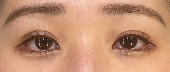 症例写真,二重まぶた・埋没法(二針固定)+吊り目矯正の症例写真,After(1ヶ月後)<br/>
(メイクありの状態),