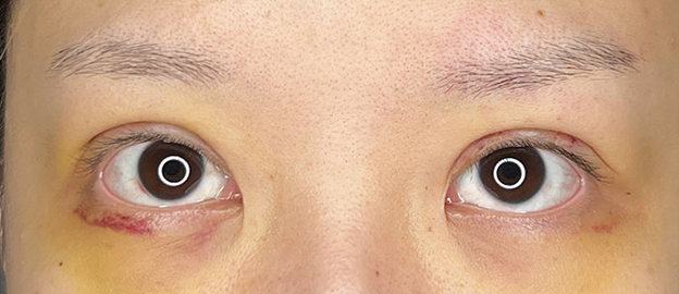二重まぶた・全切開法,他院で行った埋没法のまぶたを二重まぶた・全切開法で修正した20代女性の症例写真,術後1週間後,mainpic_sekkai095b.jpg