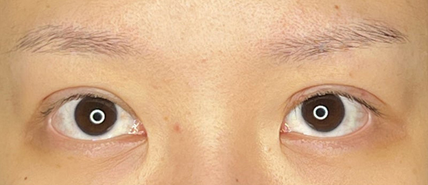 二重まぶた・全切開法,他院で行った埋没法のまぶたを二重まぶた・全切開法で修正した20代女性の症例写真,術後1ヶ月後,mainpic_sekkai095c.jpg