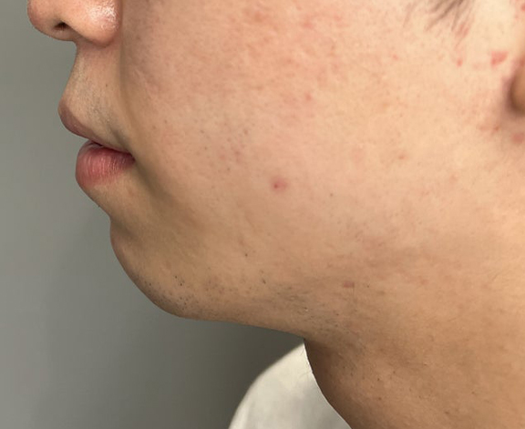 症例写真,口唇縮小術で上下の唇を薄くした20代男性の症例写真,After(3ヶ月後),ba_usuku020_b02.jpg