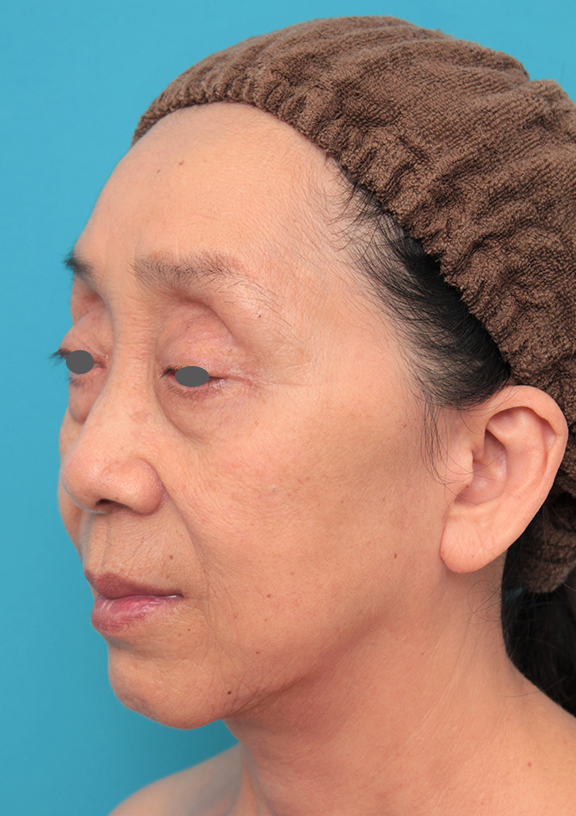 ミディアムフェイスリフト,ミディアムフェイスリフトを行った60代女性の症例写真,After(6ヶ月後),ba_mediumlift023_b02.jpg