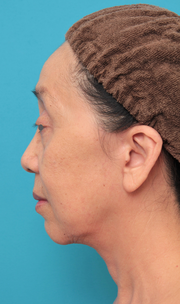 ミディアムフェイスリフト,ミディアムフェイスリフトを行った60代女性の症例写真,After(6ヶ月後),ba_mediumlift023_b03.jpg