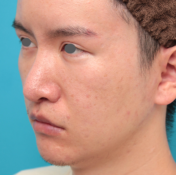 症例写真,人中短縮手術を行った20代男性の症例写真,After(2ヶ月後),ba_hanashita012_b02.jpg