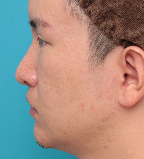症例写真,人中短縮手術を行った20代男性の症例写真,After(2ヶ月後),ba_hanashita012_b03.jpg
