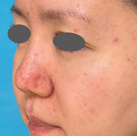 症例写真,外側法と内側法を組み合わせて施術した鼻翼縮小(小鼻縮小)の症例写真,After(1ヶ月後),ba_biyoku055_b03.jpg