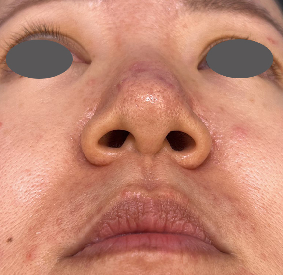 症例写真,外側法と内側法を組み合わせて施術した鼻翼縮小(小鼻縮小)の症例写真,Before,ba_biyoku055_b02.jpg
