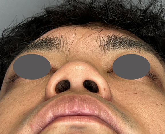 症例写真,鼻施術として、鼻翼縮小(小鼻縮小)のみを行った症例写真,After(1ヶ月後),ba_biyoku056_b02.jpg