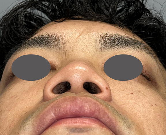症例写真,鼻施術として、鼻翼縮小(小鼻縮小)のみを行った症例写真,Before,ba_biyoku056_b02.jpg