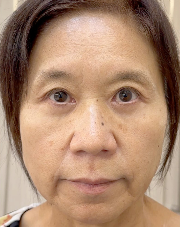 眼瞼下垂(がんけんかすい),強い窪み目と目の開けづらさを改善した眼瞼下垂の症例写真,After(3ヶ月後),ba_ganken046_b02.jpg