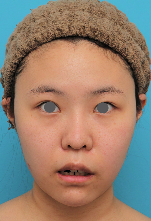 症例写真,顎シリコンプロテーゼ+下唇薄くする手術を行った20代女性の症例写真,After(2ヶ月後),ba_ago025_b02.jpg