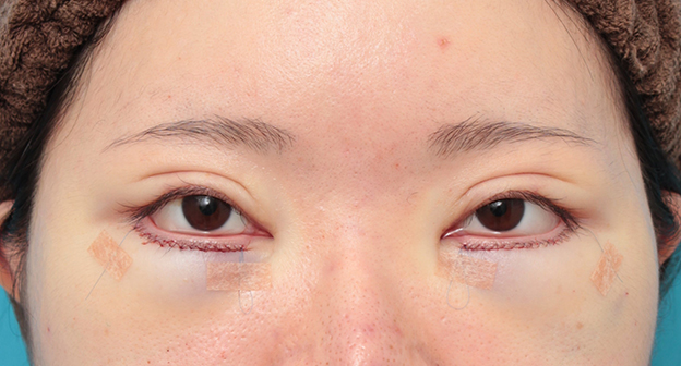 症例写真,タレ目形成手術(グラマラスライン)と目の下脂肪取り(脱脂)を同時に行った20代女性の症例写真,手術直後,mainpic_panda024b.jpg