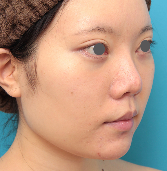 症例写真,人中短縮手術を行った20代女性の症例写真,After(9ヶ月後),ba_hanashita013_b02.jpg