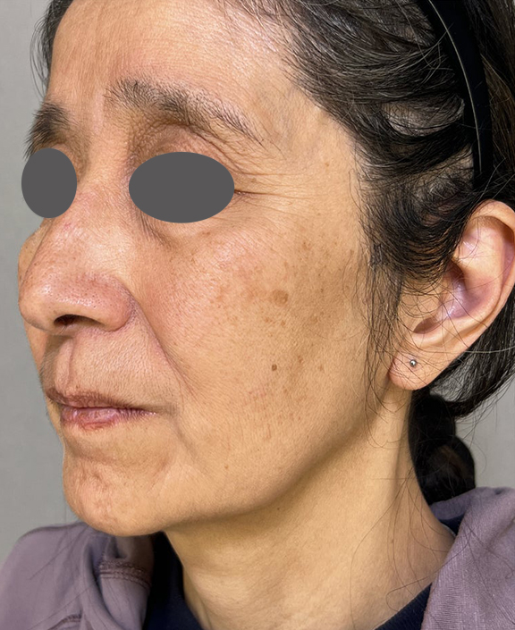ミニフェイスリフト(頬のたるみ取り),ぼやけたような印象の輪郭をミニフェイスリフトで整えた症例写真,Before,ba_minilift017_b02.jpg