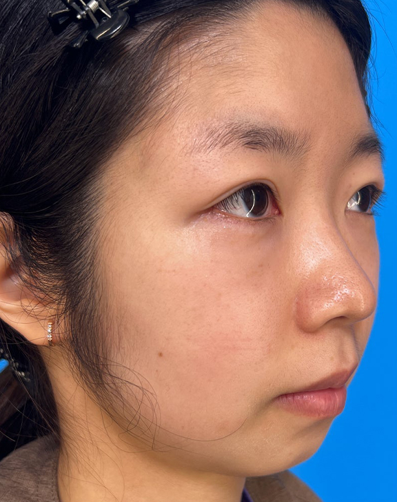ピコレーザー(PicoWay),ピコレーザーで赤みとシミを改善した症例写真,After(2ヶ月後),ba_picoway003_b03.jpg