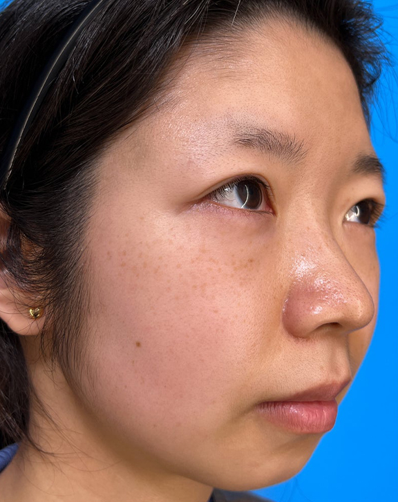 ピコレーザー(PicoWay),ピコレーザーで赤みとシミを改善した症例写真,Before,ba_picoway003_b03.jpg