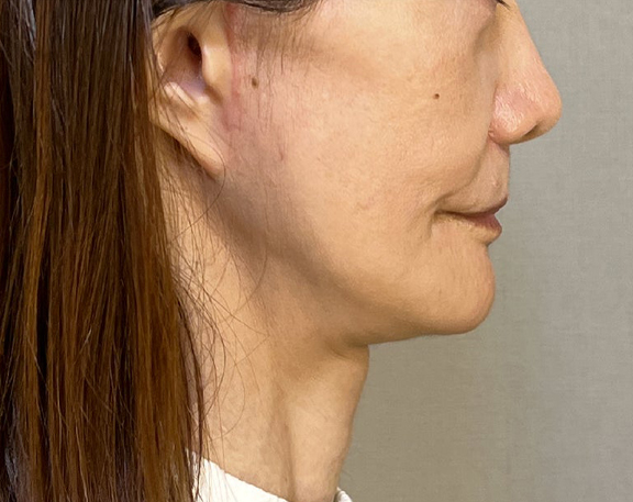ミニフェイスリフト(頬のたるみ取り),ミニフェイスリフトで頬のたるみを改善した症例写真,After(3ヶ月後),ba_minilift018_b03.jpg